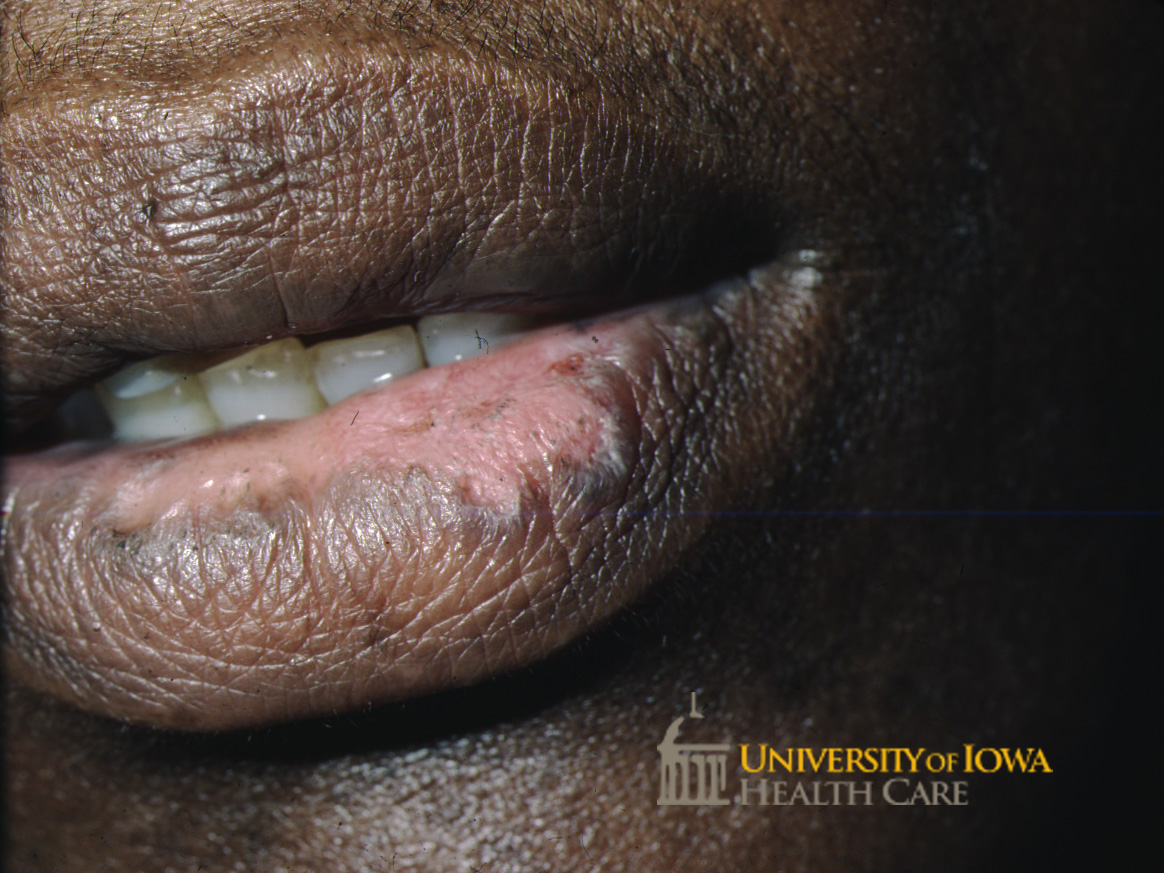 Hypopigmented eroded palques on the lower lip. (click images for higher